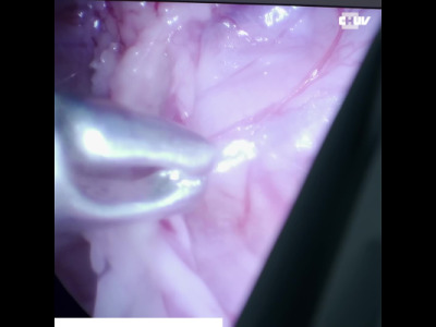 Sauver un rein comme si de rien n'était